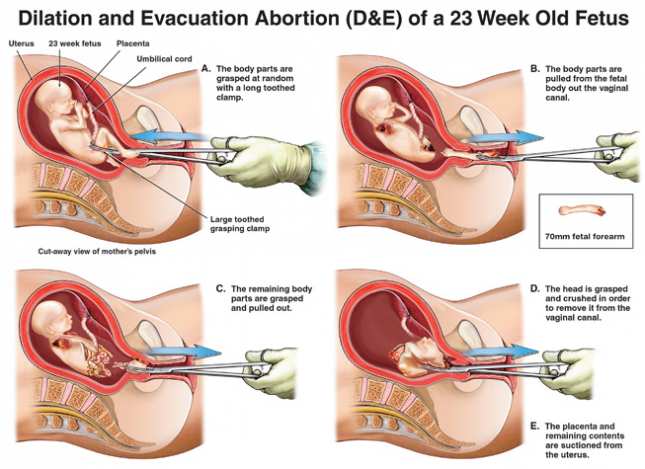 DE_abortion_645_469_55.jpg